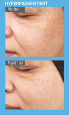Vorher/Nachher – hyperpigmentierte Haut