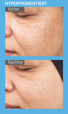Vorher/Nachher – hyperpigmentierte Haut Vorher/Nachher – hyperpigmentierte Haut